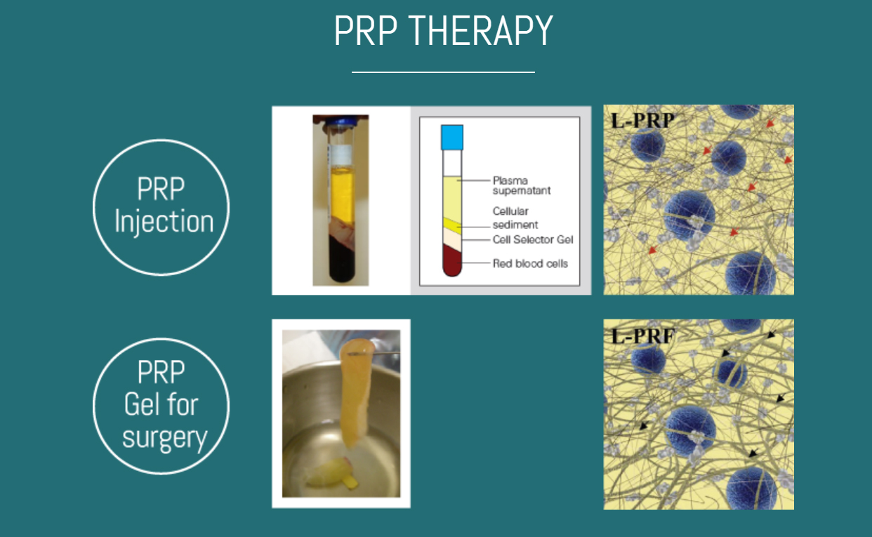 PRP THERAPY PRP THERAPY